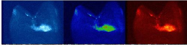 Two photon images of dental disease within an intact tooth using infrared light