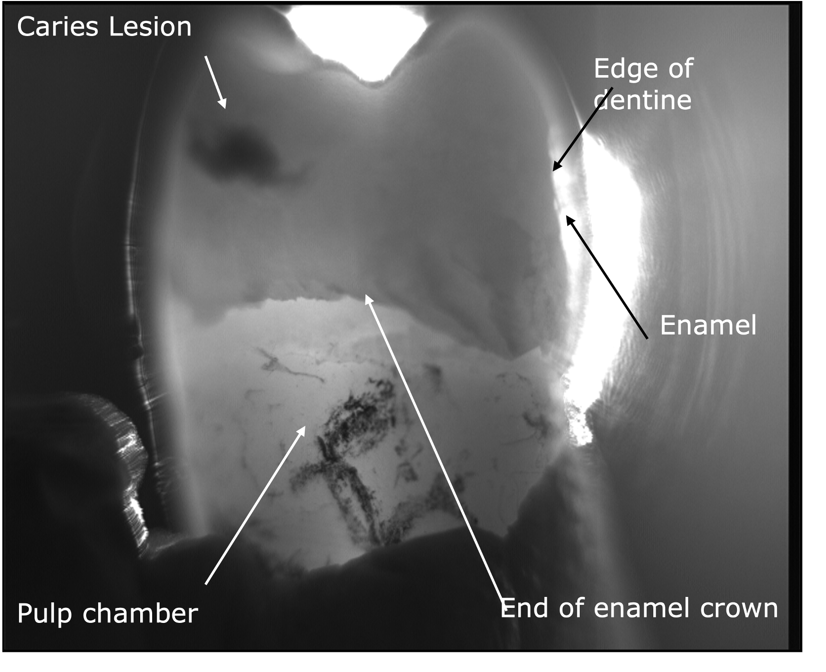Infrared transmission through an extracted tooth